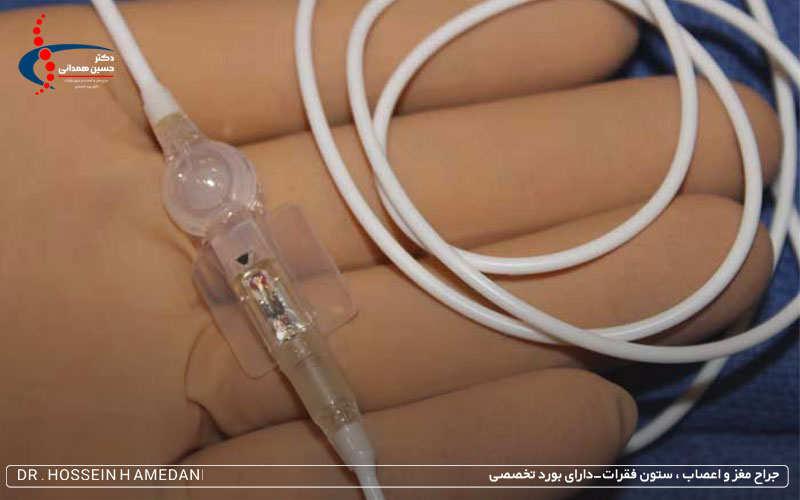 جراحی شانت مغزی