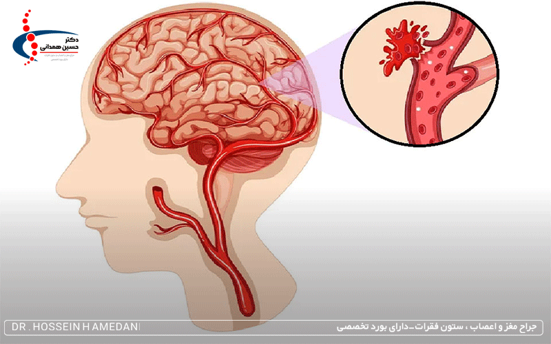 عمل جراحی خونریزی مغزی