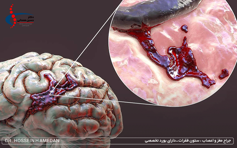 خونریزی مغزی
