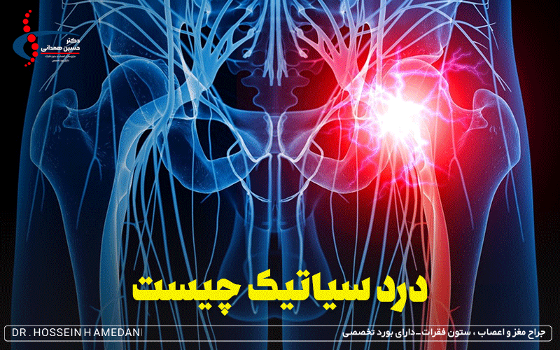 درد سیاتیک چیست