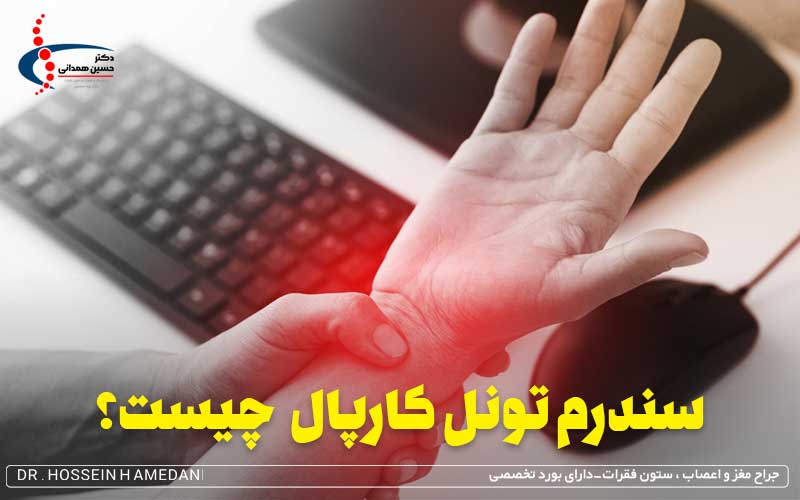 سندرم تونل کارپال چیست؟ علائم، علت و راه های درمان و تشخیص آن