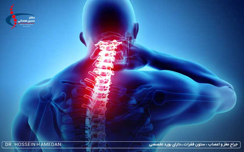 پارگی دیسک گردن چه علائمی دارد