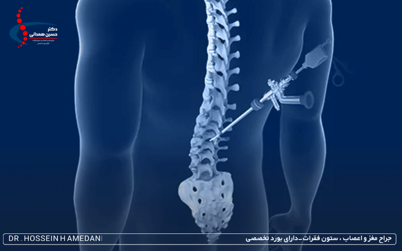 جراحی بسته دیسک کمر چیست