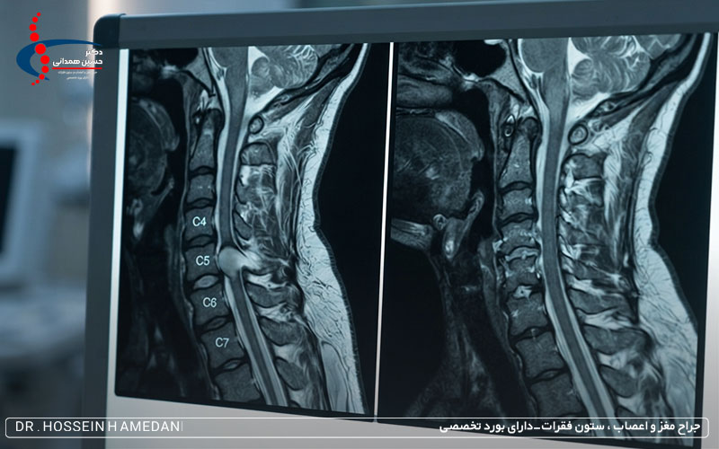 تفاوت دیسک گردن با آرتروز گردن