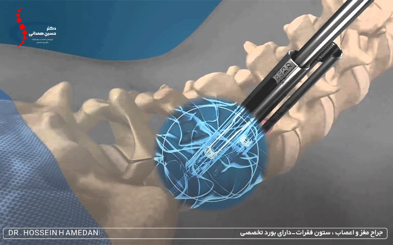 جراحی کم تهاجمی ستون فقرات
