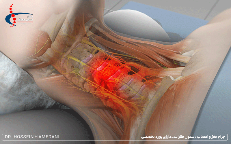عوارض بعد از عمل دیسک گردن