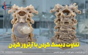 تفاوت دیسک گردن با آرتروز گردن