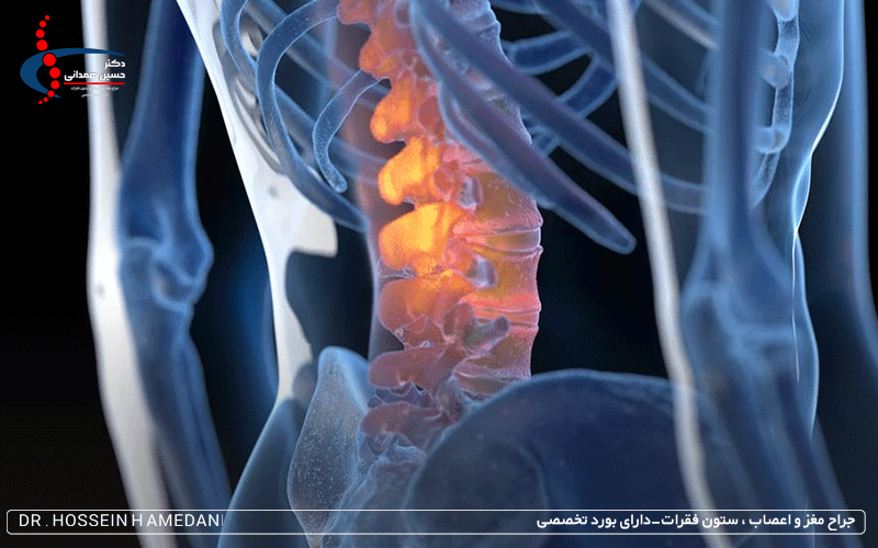 آرتروز ستون فقرات
